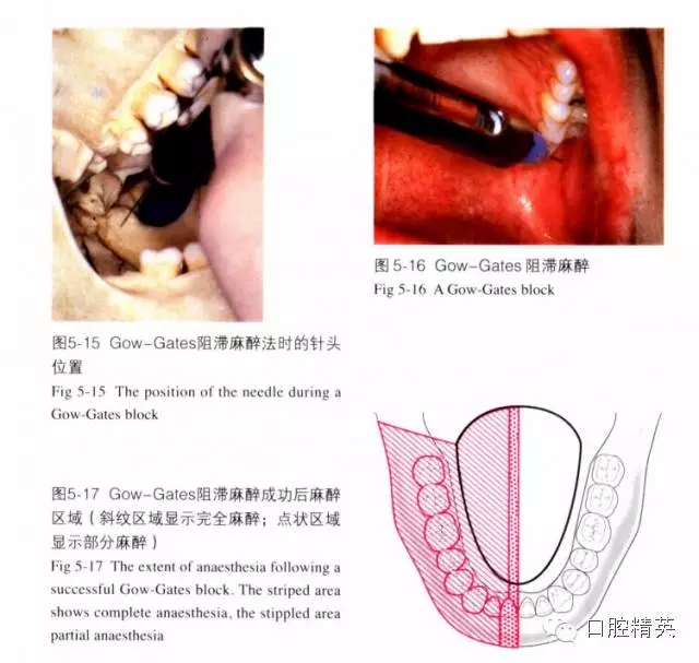 分析局部麻醉失敗的常見原因