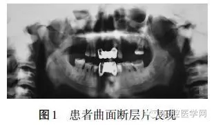 頜骨骨髓炎X線(xiàn)影像