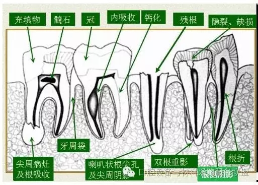 超實用的根管口的探查術