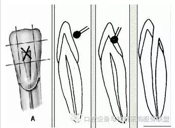 超實用的根管口的探查術