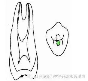 超實用的根管口的探查術