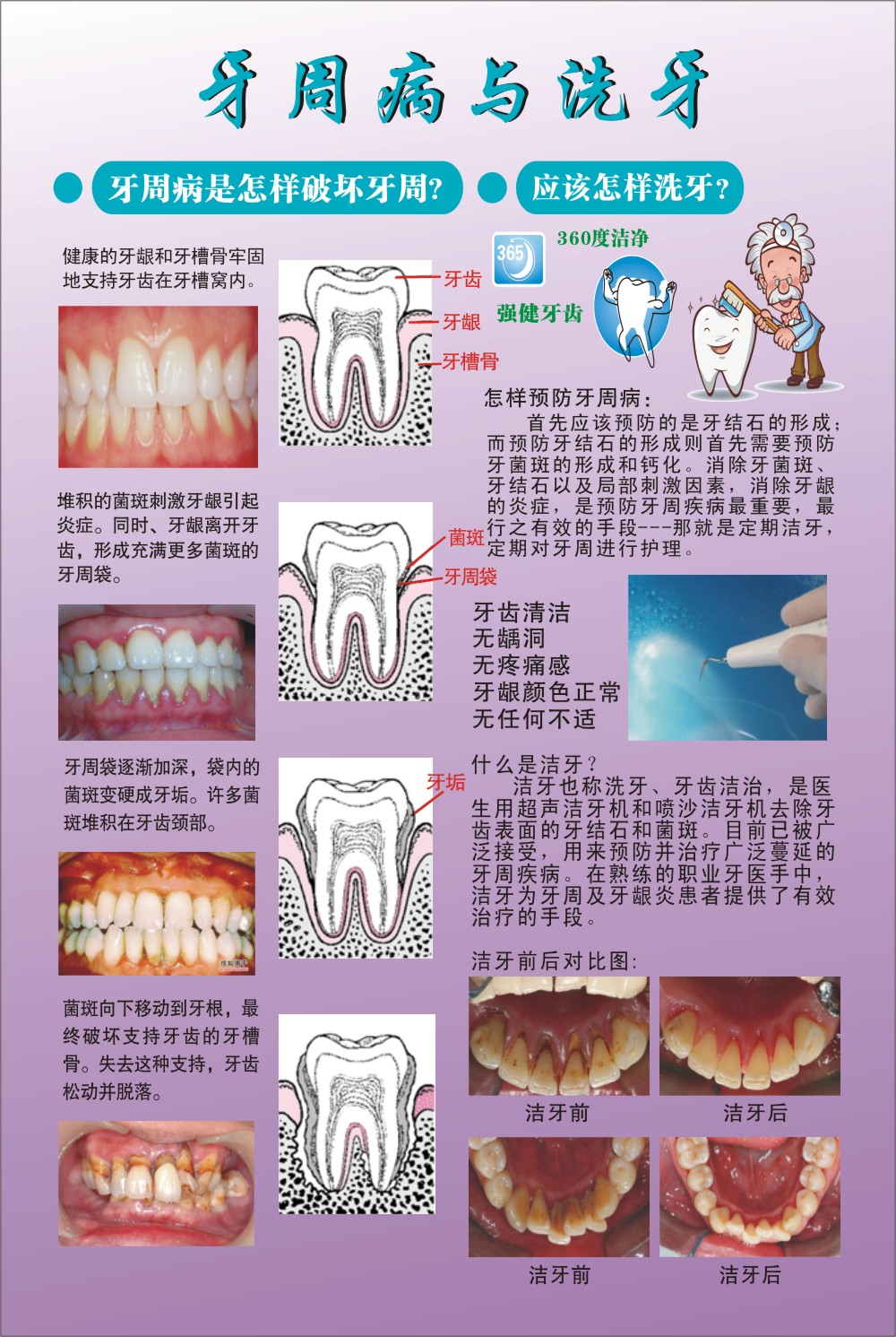 牙周病的洗牙