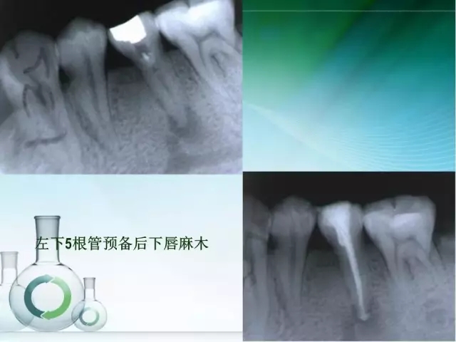 根管治療并發癥及處理