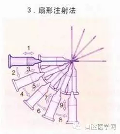 即使是老手也會失手的麻醉----下牙槽、舌、頰一次阻滯麻醉