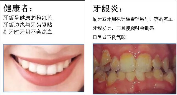 【科普】牙周病的預防和治療