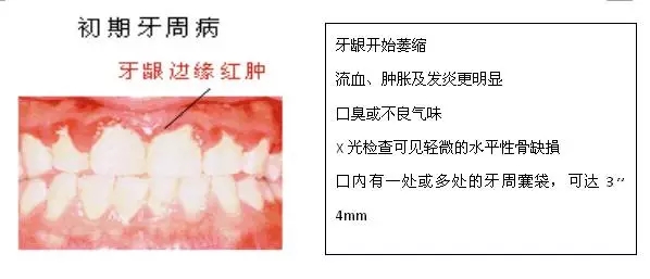 【科普】牙周病的預防和治療