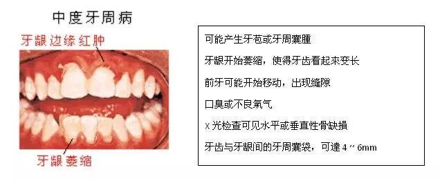 【科普】牙周病的預防和治療