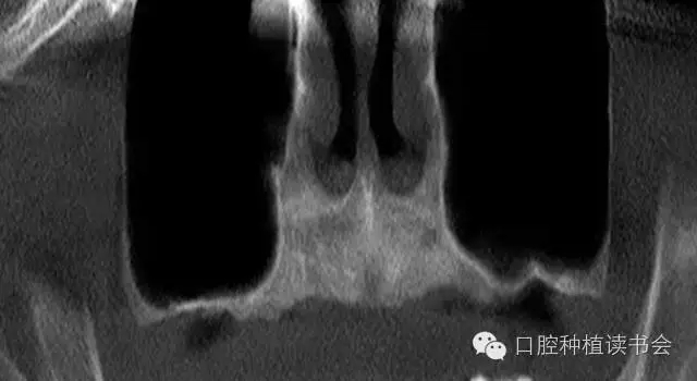 上頜后牙區(qū)種植治療的關鍵技術之—上頜竇提升術