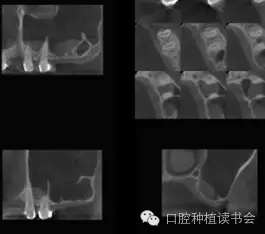 上頜后牙區(qū)種植治療的關鍵技術之—上頜竇提升術