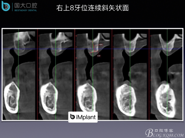 上頜竇底區(qū)域嚴(yán)重骨吸收的臨床種植案例.jpeg