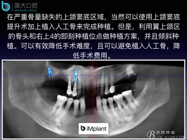 上頜竇底區(qū)域嚴(yán)重骨吸收的臨床種植案例.jpeg