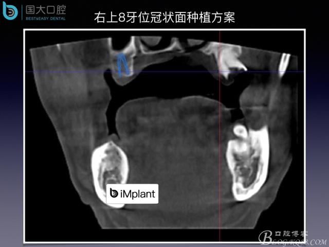 上頜竇底區(qū)域嚴(yán)重骨吸收的臨床種植案例.jpeg