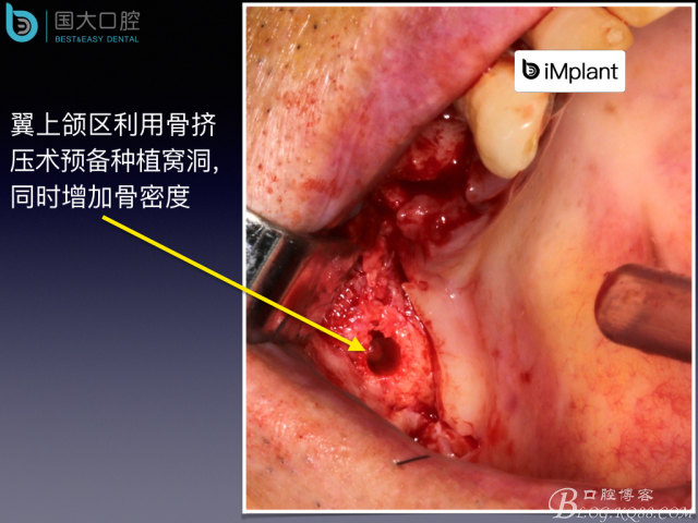 上頜竇底區(qū)域嚴(yán)重骨吸收的臨床種植案例.jpeg