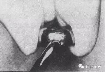 金屬預成冠修復-兒童乳牙