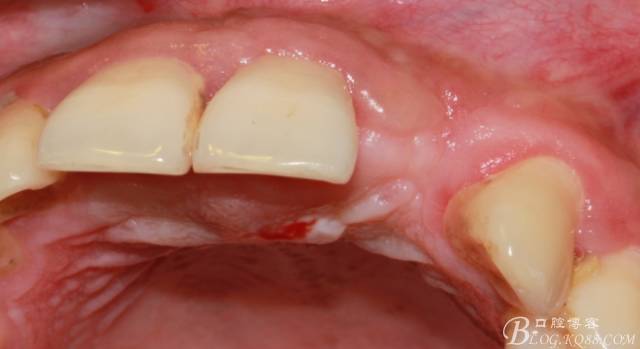 【征文大賽】一例上前牙種植失敗病例的補救--梁光強