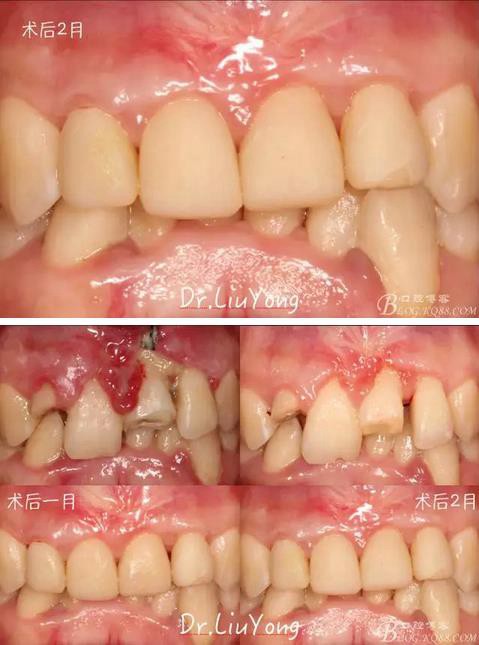 山西牙周劉勇：“前牙外傷患者的口腔多學科聯合治療”精彩案例分享