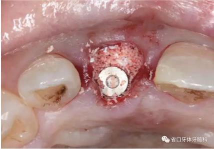 右上前牙即刻種植即刻修復1例