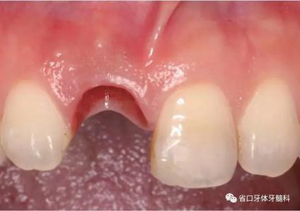 右上前牙即刻種植即刻修復1例