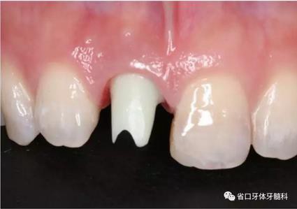 右上前牙即刻種植即刻修復1例
