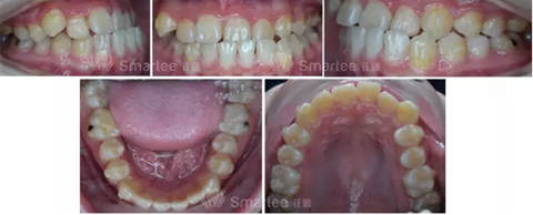 【病例展示】Smartee隱形正畸中國好病例鑒賞第三波
