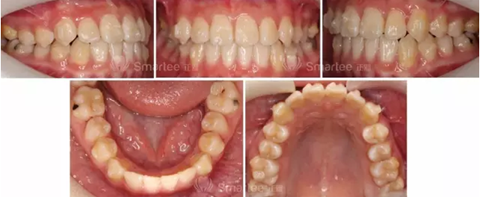 【病例展示】Smartee隱形正畸中國好病例鑒賞第三波