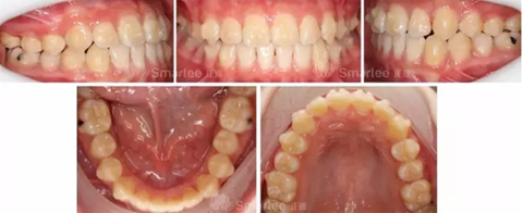 【病例展示】Smartee隱形正畸中國好病例鑒賞第三波