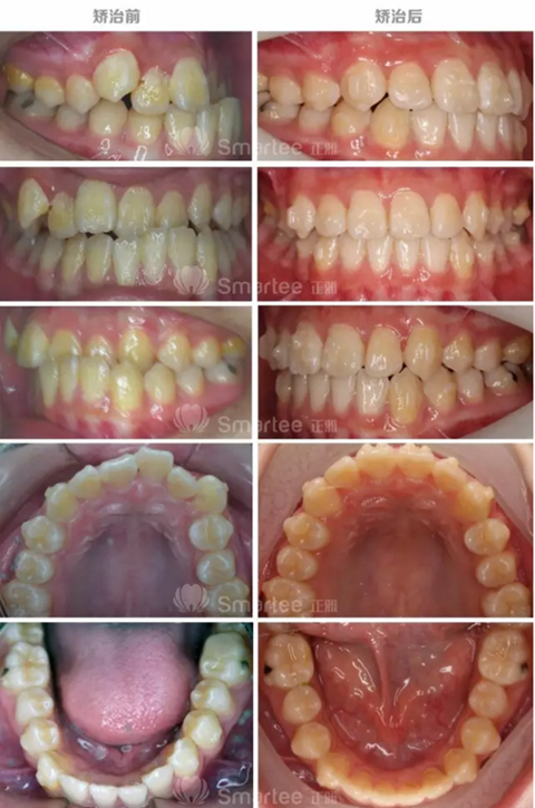 【病例展示】Smartee隱形正畸中國好病例鑒賞第三波