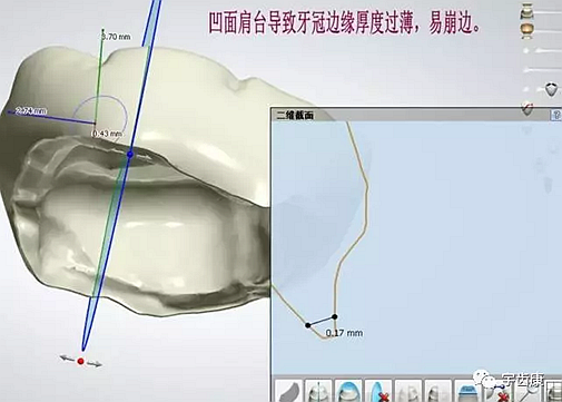 影響全瓷牙冠裂的因素有哪些？