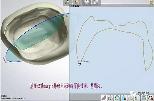 影響全瓷牙冠裂的因素有哪些？