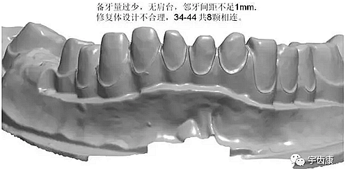 影響全瓷牙冠裂的因素有哪些？