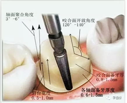 影響全瓷牙冠裂的因素有哪些？