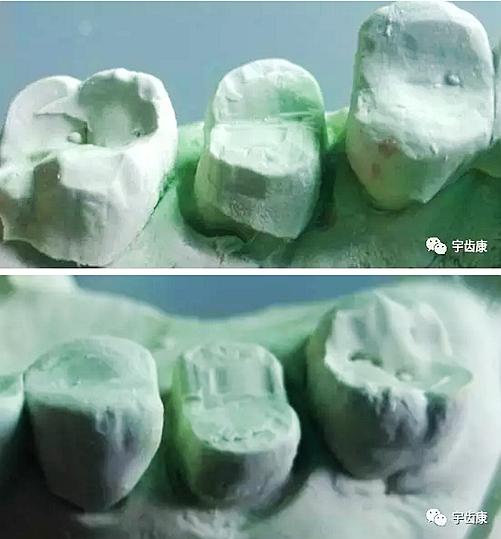 影響全瓷牙冠裂的因素有哪些？