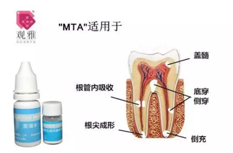 “觀雅”MTA修補側穿一例