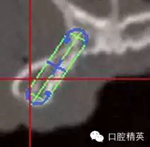 口腔種植各種失敗模式的病因探查