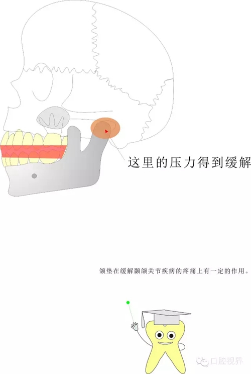 【愛牙科普知識300問】 “什么是頜（牙）墊？”