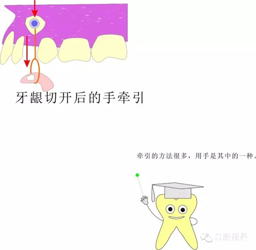 【愛牙科普知識300問】 “什么是頜（牙）墊？”