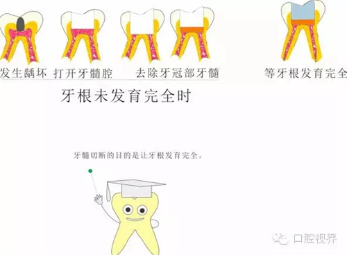 【愛牙科普知識300問】 “什么是活髓切斷術？”