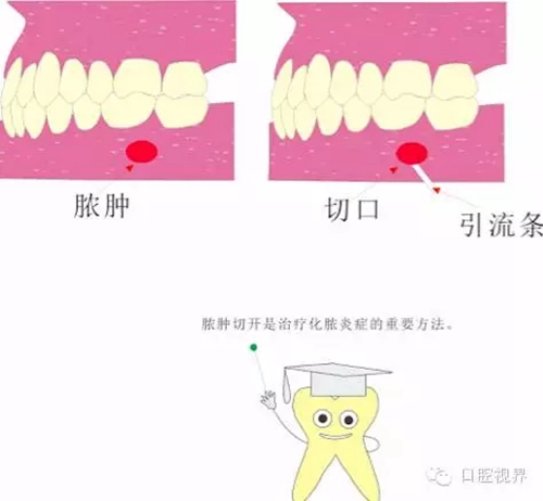 【愛牙科普知識300問】 “什么是活髓切斷術？”