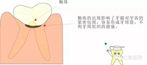 【愛(ài)牙科普知識(shí)300問(wèn)】 “什么是融合牙、愈合牙和雙生牙？”