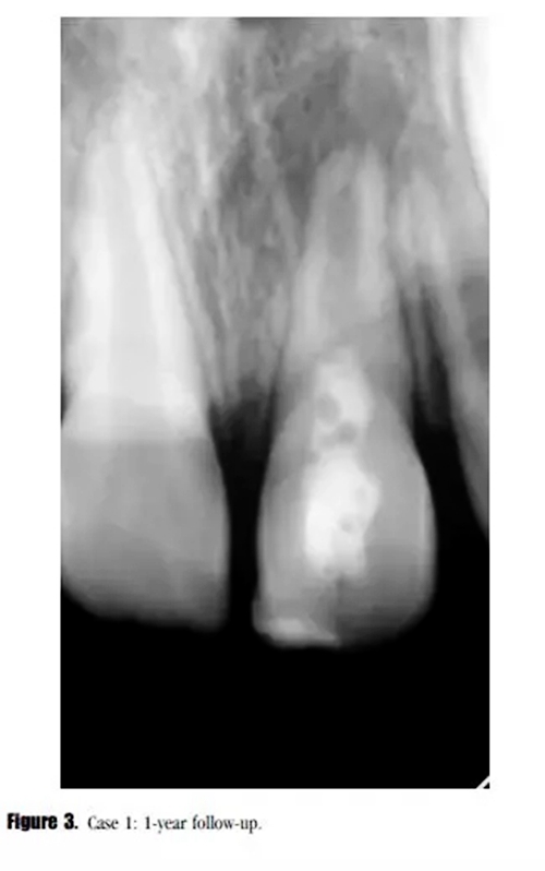 病例分享｜牙髓血管再生治療失敗后的牙根發育：2例