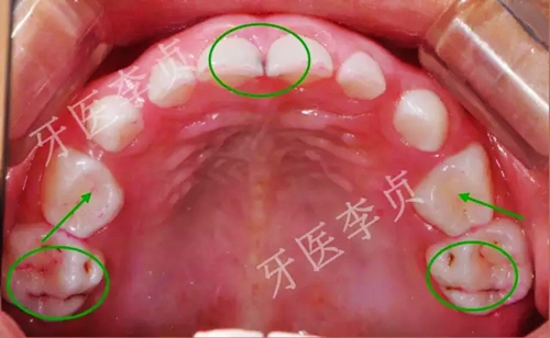 兒牙病例|兒童蛀牙的修復