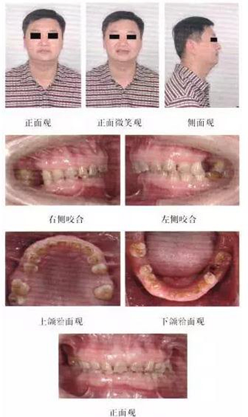 正畸修復聯合咬合重建1例 