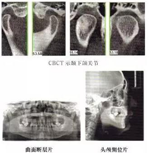 正畸修復聯合咬合重建1例 