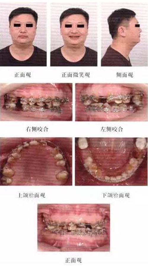 正畸修復聯合咬合重建1例 