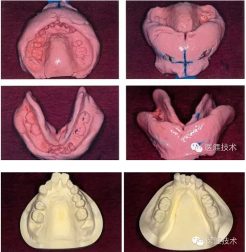 全口拔牙即戴全口活動義齒修復病例 