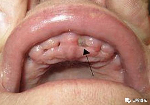口腔激光在干槽癥中的應用