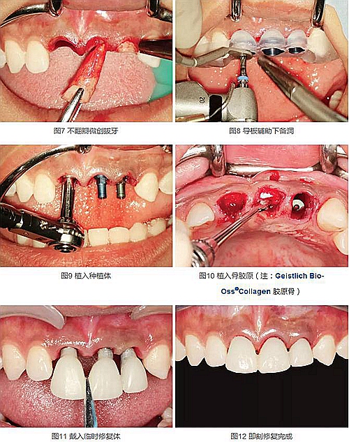 上頜多顆相鄰前牙的“精確化”即刻種植修復