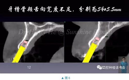 短種植體在前牙美學區應用的臨床病例報道（上）