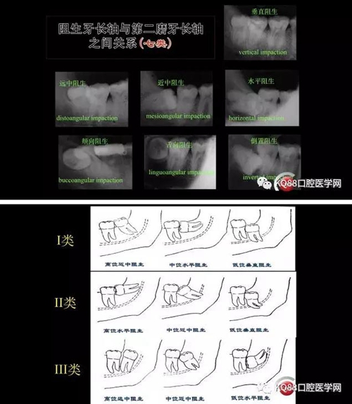 智齒拔除