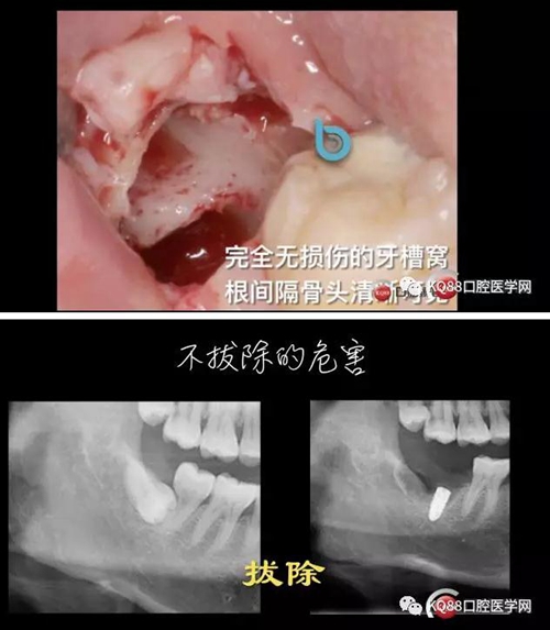 智齒拔除